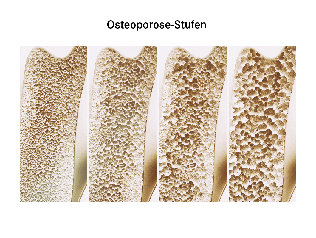 Osteoporose-Stufen