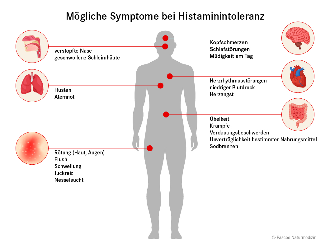 Mögliche Symptome bei Histaminintoleranz: Husten, Kopfschmerzen, Übelkeit, etc.