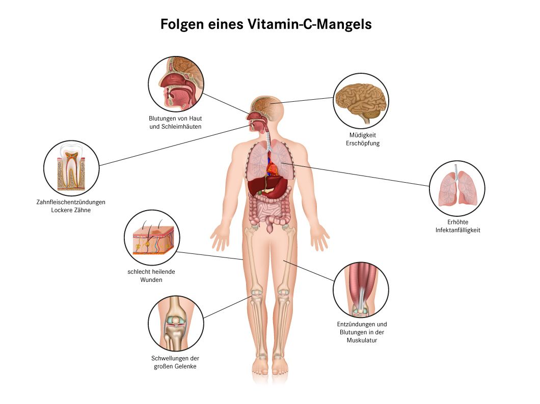 Vitamin-C-Mangel Folgen - Abbildung eines Menschens mit der Abbildung der Folgen drum herum 