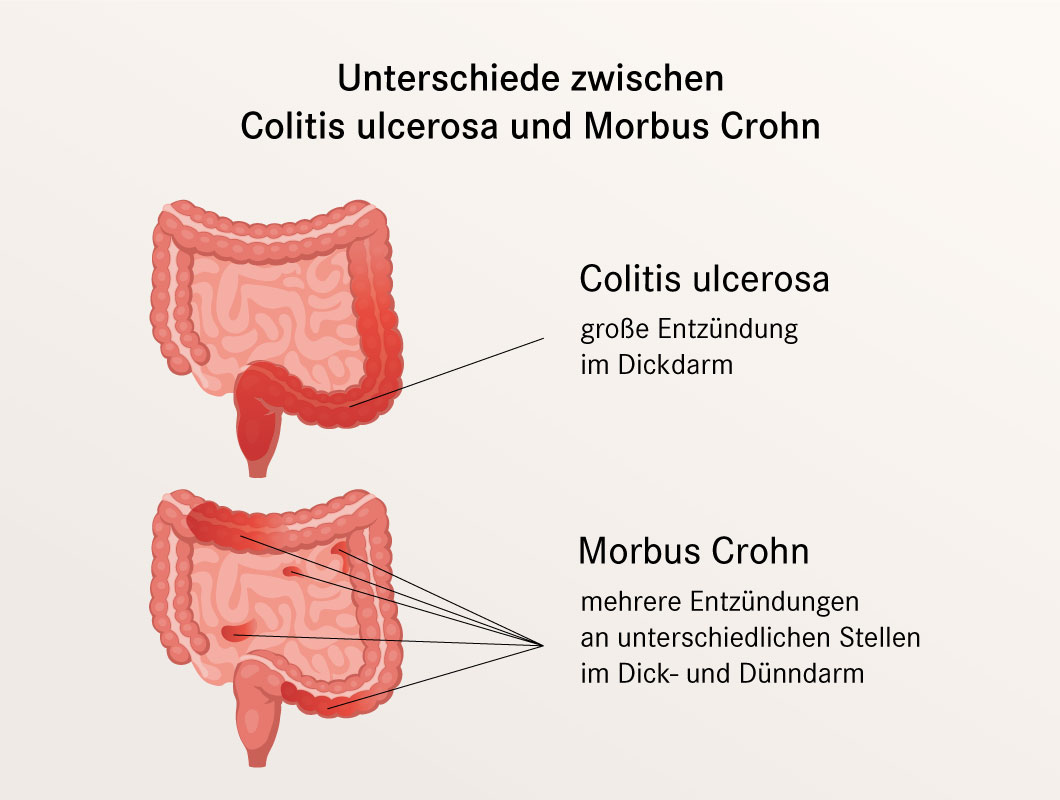 Unterschiede zwischen Colitis ulcerosa und Morbus Crohn