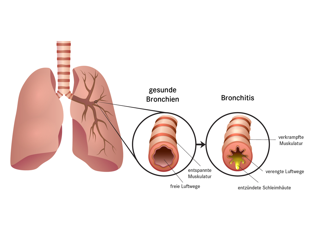 Schematische Darstellung Lunge und Luftwege, gesunde Bronchien versus Bronchitis. Darstellung entzündeter Schleimhäute und verengter Luftwege