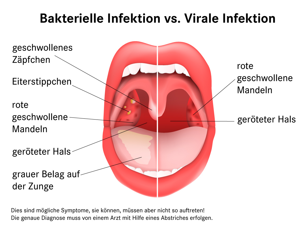 Bakterielle vs. virale Infektion mit Darstellung der Symptome im Mund- und Rachenraum