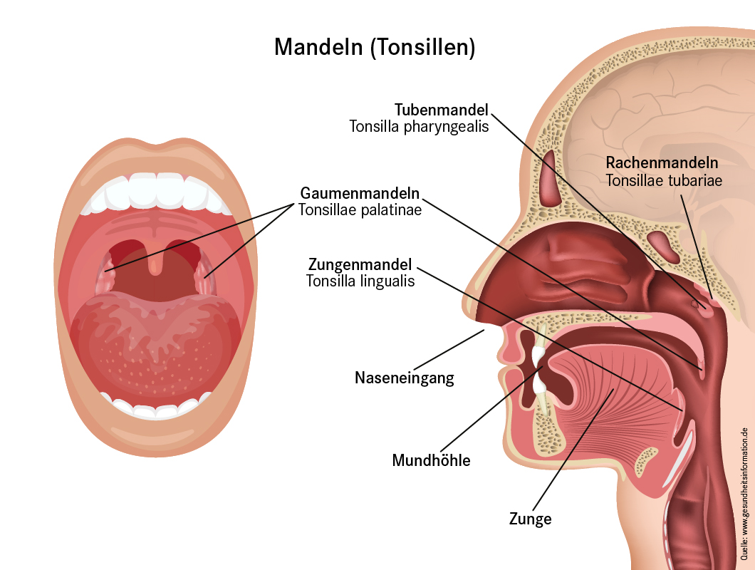 Abbildung Mandeln (Tonsillen): Gaumenmandel, Rachenmandel, etc.